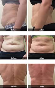 We did not find results for: Coolsculpting In Ca Tx Wa Fat Reduction Skinspirit