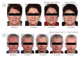 Ivermectin is a medication used to treat many types of parasite infestations. Rosacea The Patient Experience Is Now Clear European Medical Journal