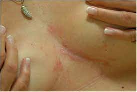 The condition is most commonly found in the groin, axillae, and inframammary folds. Intertrigo Springerlink