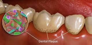 It has very little impact on white, soft. How To Get Rid Of Plaque The Effective Way