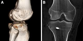 Image result for Segond Fracture