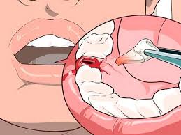 Image result for Alveolitis sicca)