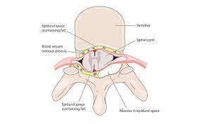 Image result for Spinal Epidural Abscess