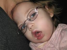 Children with Multiple Disabilities: What Does a Deaf-Blind Diagnosis Look  Like?