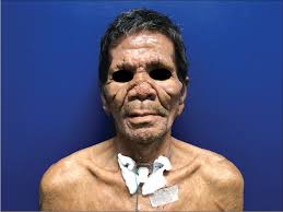Image result for Leprosy
