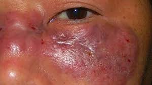 There are several key signs which point towards mucormycosis. Mucormycosis Symptoms Causes Pictures Treatment And More
