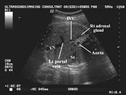Abdominal Circumference Medical Ultrasound Obstetric Ultrasound Ultrasound