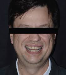 Correction of Vertical Smile Discrepancy through Ceramic Laminate Veneers  and Surgical Crown Lengthening