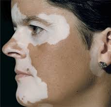 When a patient has vitiligo, the wood's light makes all of the white spots fluoresce bright white, making them clearly visible in contrast to the normal skin color, even if the normal skin is very pale. 13 Pigmentary Disorders Plastic Surgery Key