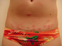 There are high chances of getting bites from chiggers if you are exposed to an area having chiggers. Young Girl With A Pruritic Rash