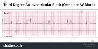 Image result for Atrioventricular Block