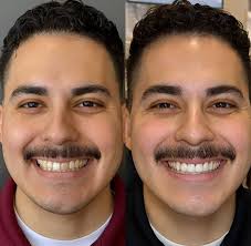 4 porcelain veneers to transform this smile. Sometimes 4 is all it takes.  Every smile is different. If you're interested in options to improve your  smile, come see me!! Creating beautiful smiles