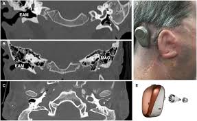 It consists of a bony (inner) portion and a fibrocartilaginous (outer) portion, the cartilaginous external acoustic meatus. Frontiers Anatomy And Development Of The Mammalian External Auditory Canal Implications For Understanding Canal Disease And Deformity Cell And Developmental Biology