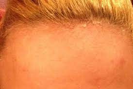 Un data says that 40% of african women bleach their skin. Bleached My Forehead With Hair Bleach What Do I Need To Do To Revive My Skin Photo