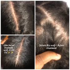 Natural Hair Oil For Psoriasis And Dry Flaky Scalp Label Says Anti Breakage In 2020 Natural Hair Oils Dry Flaky Scalp Hair Oil