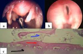 Hand selected websites about pallister hall syndrome. Bifid Epiglottis With Midline Laryngeal Hamartoma A Rare Presentation Of Pallister Hall Syndrome Semantic Scholar