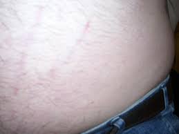 Streifen Auf Meinen Bauch Gesundheit Korper Haut
