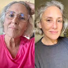 Ricki Lake, 56, has unveiled the incredible results of a deep-plane lower  face and neck lift she underwent a year ago. “I had lost 40 lbs and did not  like the extra