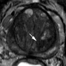The american cancer society provides detailed information on prostate cancer and its treatment. Transition Zone Prostate Mri