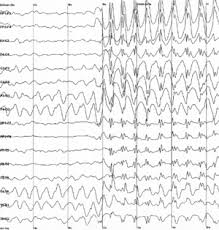 When seizures occur repeatedly, this usually indicates a seizure. Seizure Wikipedia