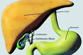 Image result for Gallstone