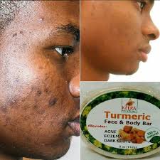 PRICE: $802(TAX INCLUDED) Say Goodbye to blemished acne prone skin! Using  turmeric soap helps acne prone skin get the proper treatment it needs.  Turmeric soap gently exfoliates excess skin, stimulates blood circulation