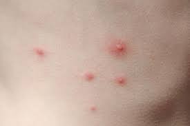 Childhood Rashes Mydr Com Au