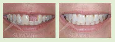 She Is A Middle Aged Woman Who Had Her Front Tooth Knocked Out Around Twenty Years Ago It Was Finally Replaced Wit Tooth Crown Tooth Replacement Dental Crowns