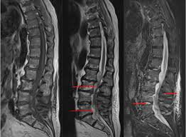 Image result for Spinal Infection