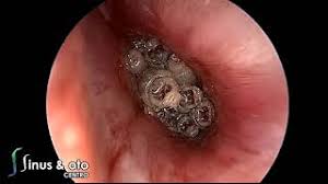 I use to be a cosmetologist did this for 10 yes i loved my job the money was awesome above all i loved me! Myiasis Of The Ear Youtube