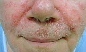 Kişileri günlük hayatında bile rahatsız eden seboreik dermatit'in belirtileri nasıldır? Seboreik Dermatit Seboreik Egzema Olarak Prof Dr Kamer Gunduz Facebook