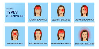 Image result for Acute Localized Headache