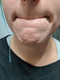 Skin Concerns How Do I Get Rid Of These White Things On My Chin I Can Literally Use Tweezers And Pluck Them Out Of My Pores Skincareaddiction