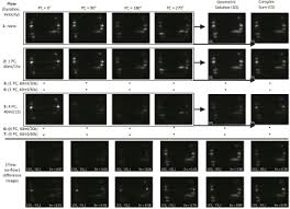 June 3, 2021 june 2, 2021 by health juki ad_1 breast cancer: Ismrm20 Digital Posters Page Acquisition Reconstruction Analysis Mitigating Motion Artifacts And Imperfections