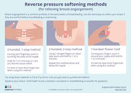 Breast engorgement | Pregnancy Birth and Baby
