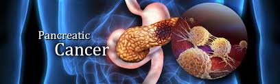 Pancreatic cancer is cancer that starts in the pancreas. Pancreatic Cancer Tumor Markers Genetex