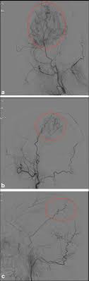 Matsushima grade. a Grade A. b Grade B. c Grade C | Download Scientific  Diagram