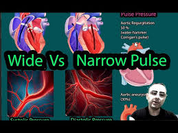 Image result for Pulse Pressure