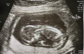 14週雙胞胎第二個寶寶沒心跳，引產紀錄@Nini and Blue 玩樂食記