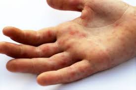 Hand Fuss Mund Krankheit Bilder Symptome Ansteckung Behandlung Hausmittel