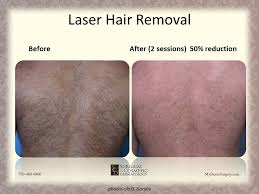 Maybe you would like to learn more about one of these? Laser Hair Removal Newnan Permanent Hair Reduction Peachtree City Ingrown Hairs Lagrange