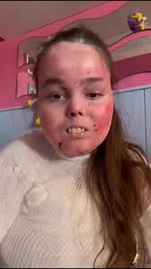 por favor vamos a compartir este vídeo, vamos a ayudar a Dunia, a conseguir  lo que es un derecho para todos los niños y niñas que sufren esa terrible  enfermedad Piel Mariposa, no es su privilegio, es ...