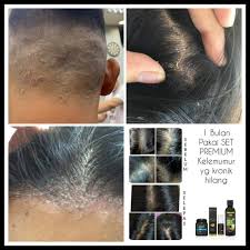 Kelemumur, serpihan putih yang sedikit menjengkelkan yang terkumpul di rambut, boleh menjadi keadaan yang memalukan, tetapi ketahuilah bahawa mungkin untuk menghilangkan kegusaran ini. Punca Kelemumur Di Kepala