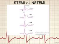 A study comparing outcomes from anterior and inferior infarctions (stemi + nstemi) found that compared with inferior mi, patients with anterior mi had higher incidences of: 8 Best Stemi Vs Nstemi Ideas Cardiac Nursing Nursing Notes Nursing School Survival