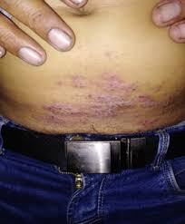 Dermatitis Alergica De Contacto Periumbilical