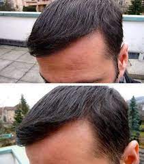 Dr Keser 2100 Grafts Fue Turkey Hairtransplant Hairtransplantistanbul Hairtransplantdoctor Hairt Hair Transplant Hair Transplant Uk Hair Transplant Surgery