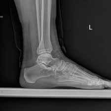 Image result for Foot XRay