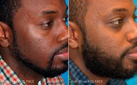 Rooted in history and modified through the years, we have seen many iterations and styles on black men with curly hair should embrace their look by rocking a full head of curls. Hair Restoration Virginia Beach Follicular Unit Extraction Norfolk