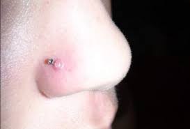 Nose Piercing Bumps What Are They And How To Get Rid Of Them Pierced