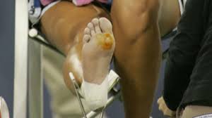 Muchos de los problemas de piel en los pies pueden ser una fuente de verguenza para los pacientes, les da tanta pena que no reciben tratamiento por lo avergonzados que están. Como Evitar Las Ampollas Y Otros Problemas En Los Pies Al Hacer Ejercicio Bbc News Mundo